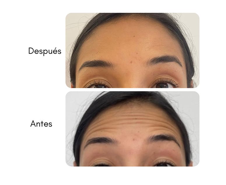 botox