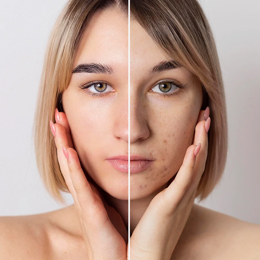 tratamiento para acne mesoterapia